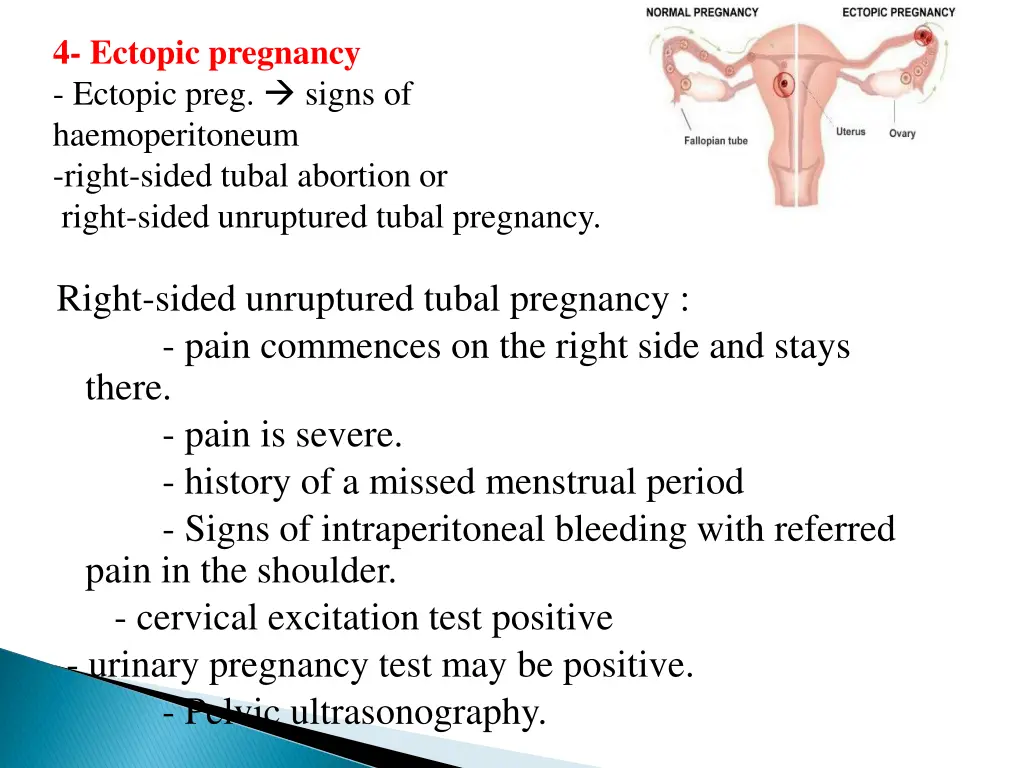 4 ectopic pregnancy ectopic preg signs