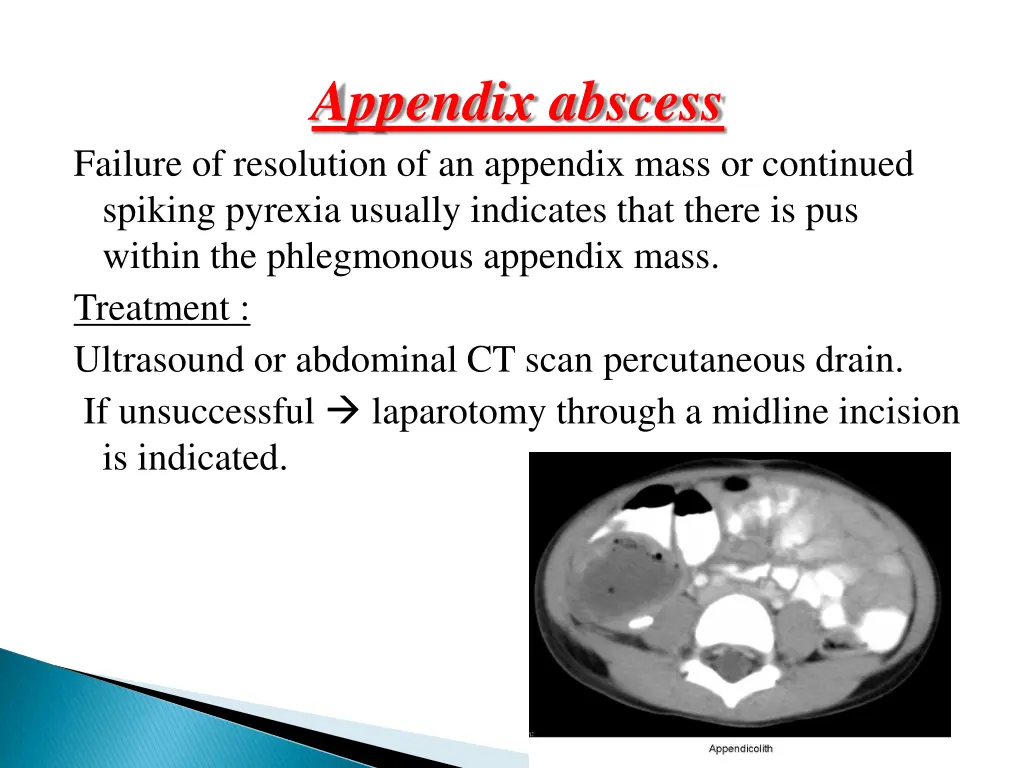 appendix abscess