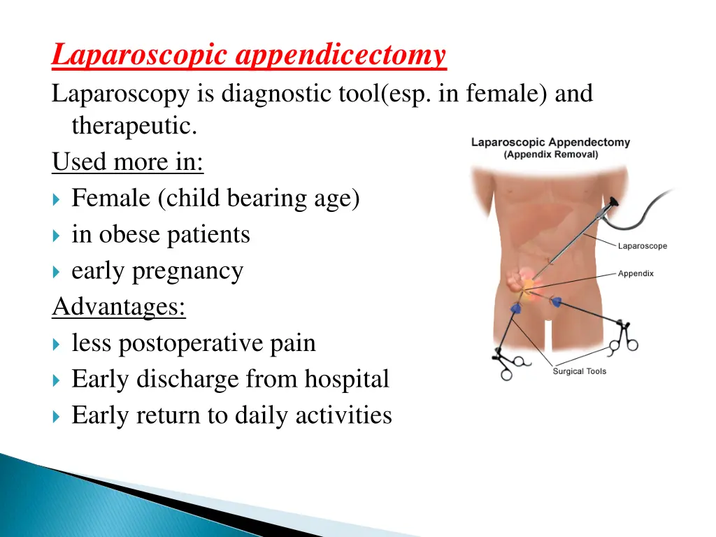 laparoscopic appendicectomy laparoscopy