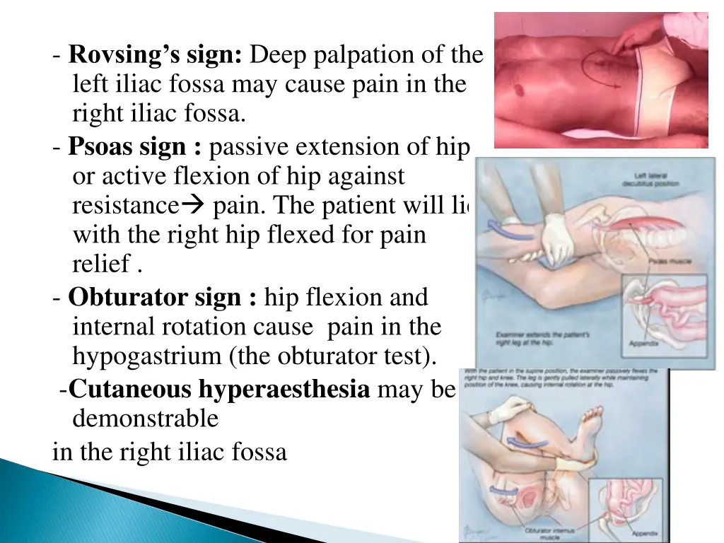 rovsing s sign deep palpation of the left iliac
