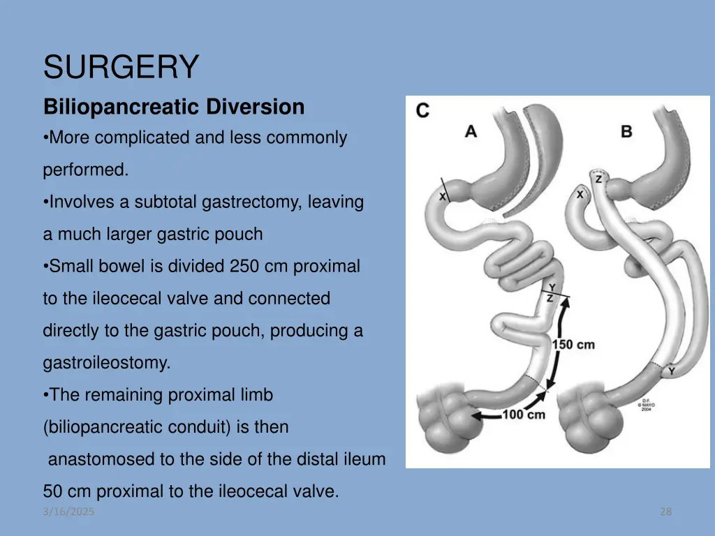 surgery biliopancreatic diversion more