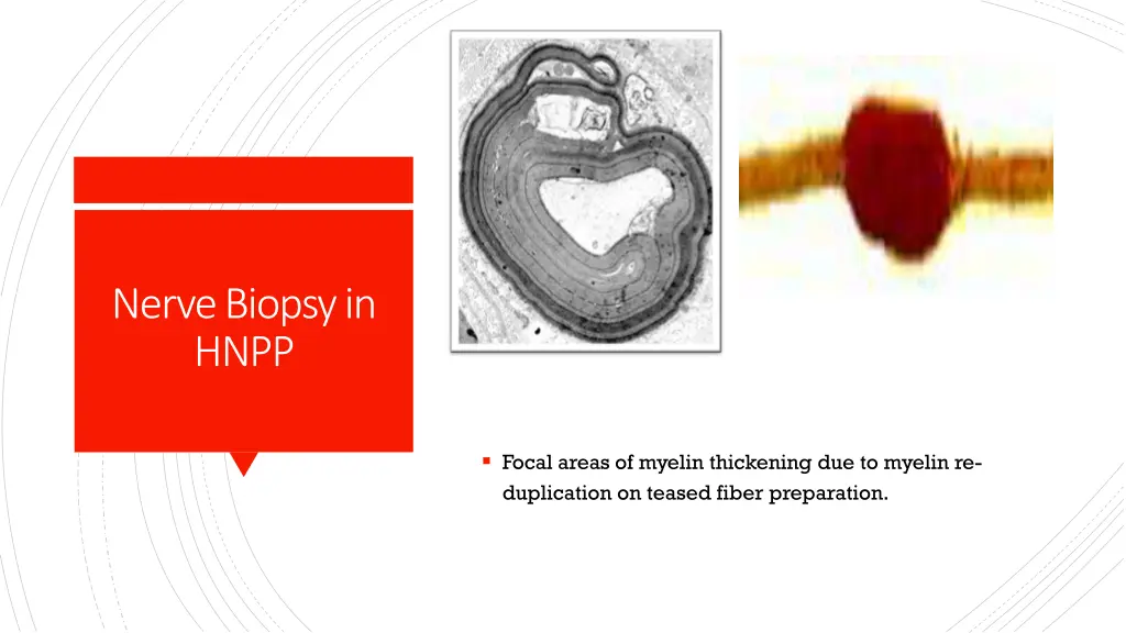 nerve biopsy in hnpp