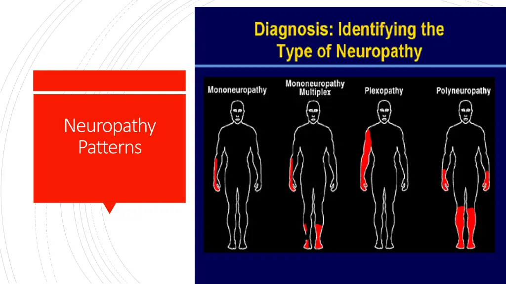 neuropathy patterns