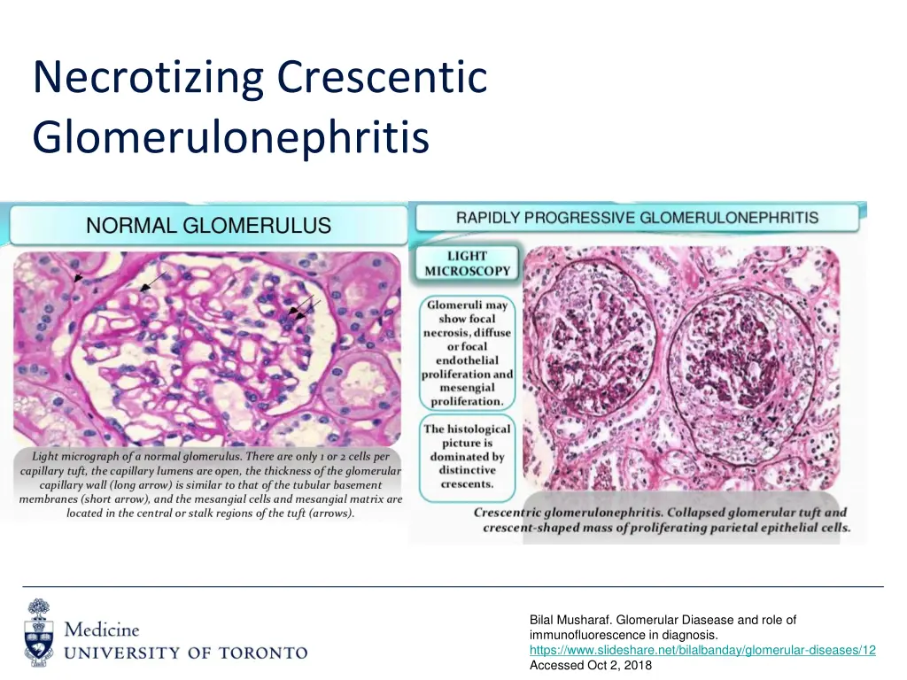 necrotizing crescentic glomerulonephritis