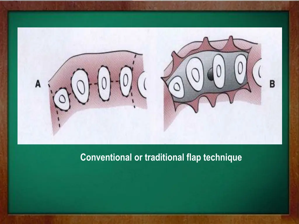 conventional or traditional flap technique