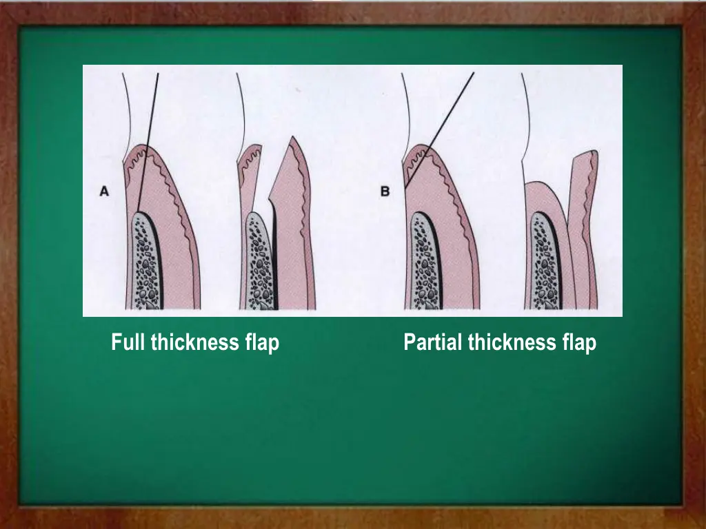full thickness flap partial thickness flap