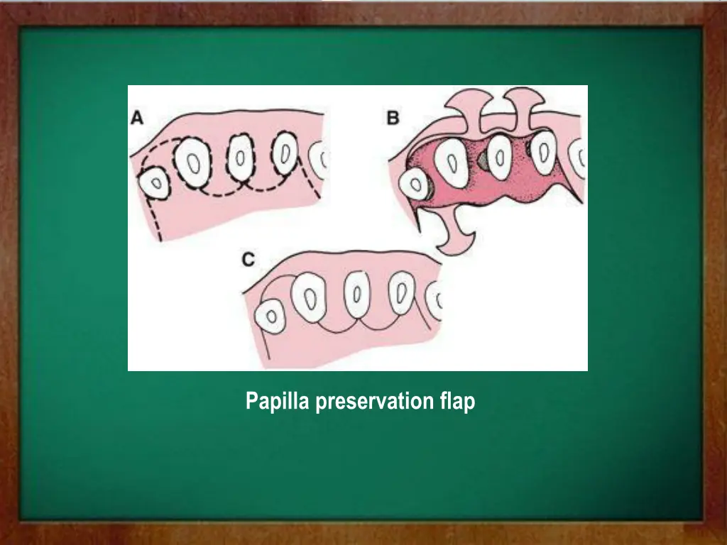 papilla preservation flap 1