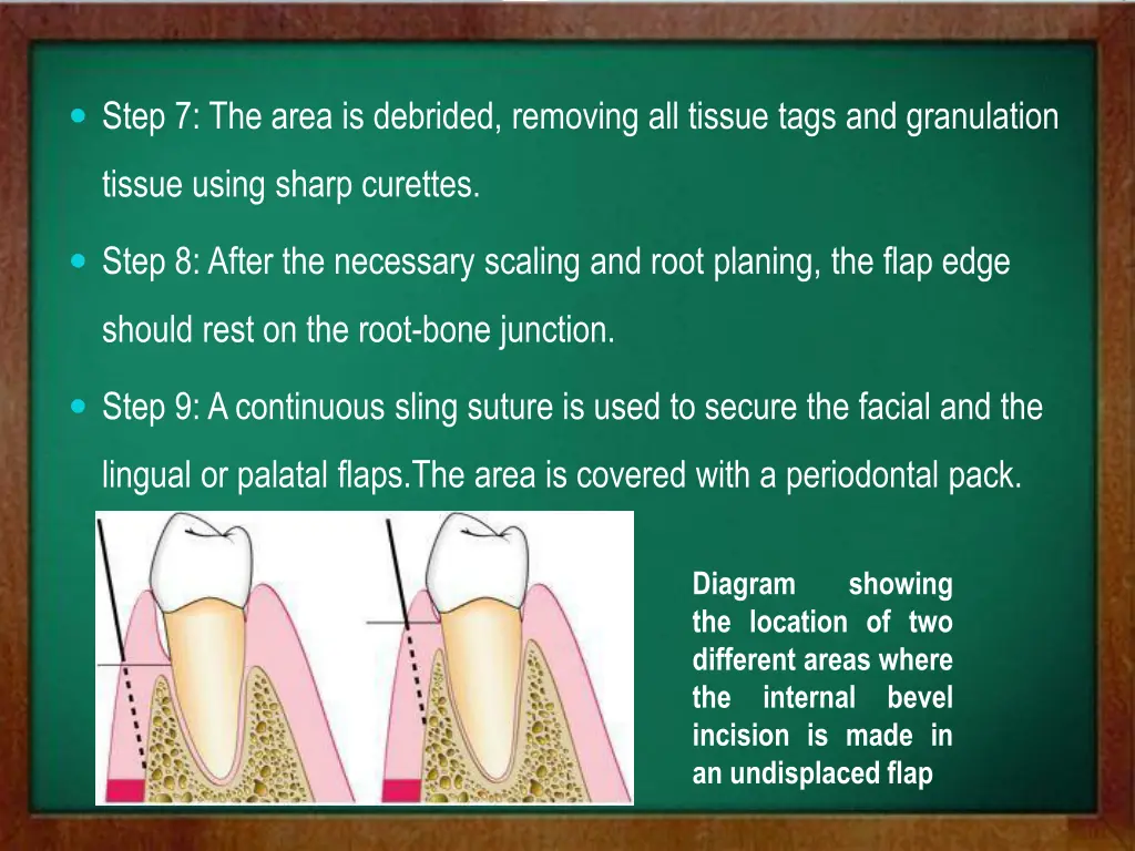 step 7 the area is debrided removing all tissue