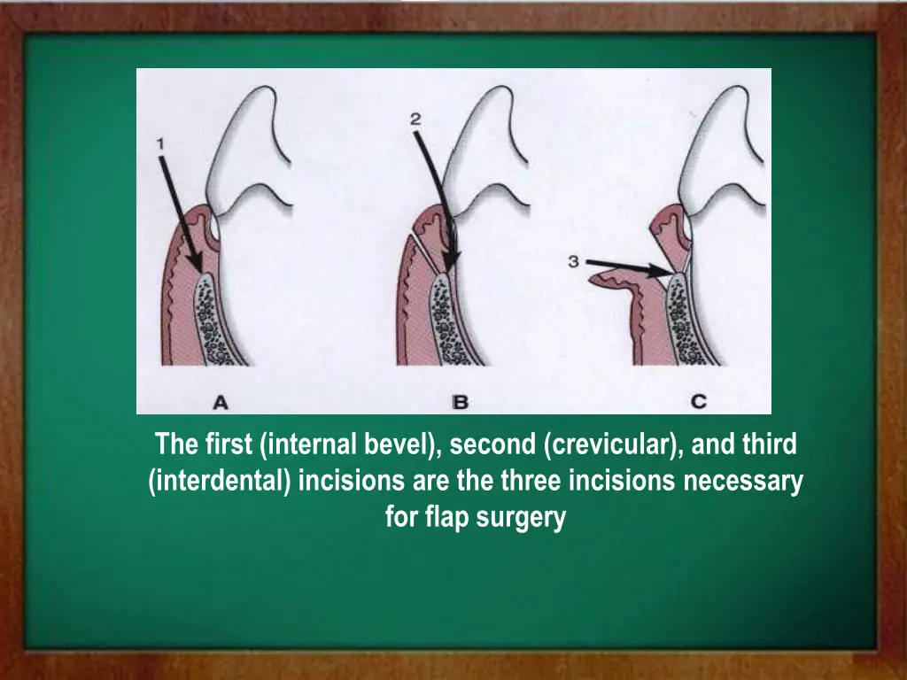 the first internal bevel second crevicular