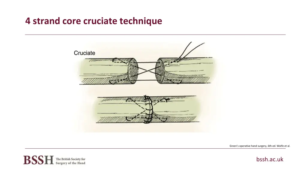 4 strand core cruciate technique