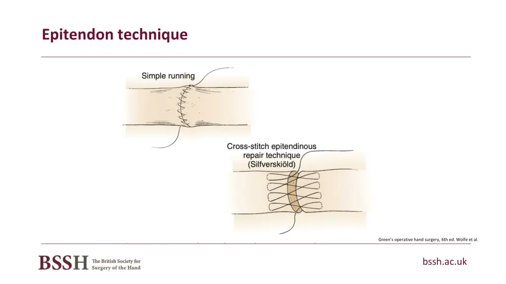 epitendon technique