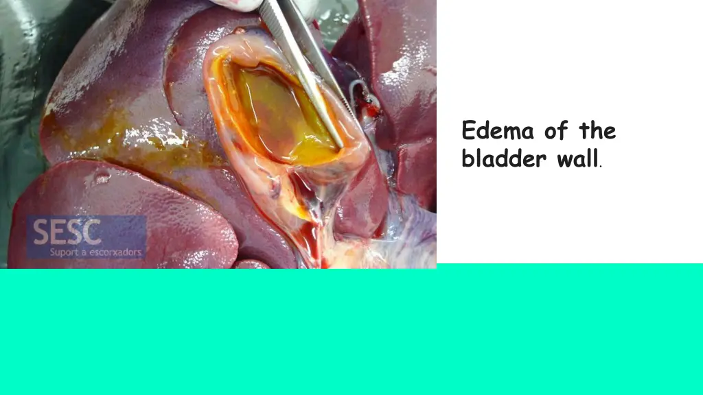 edema of the bladder wall
