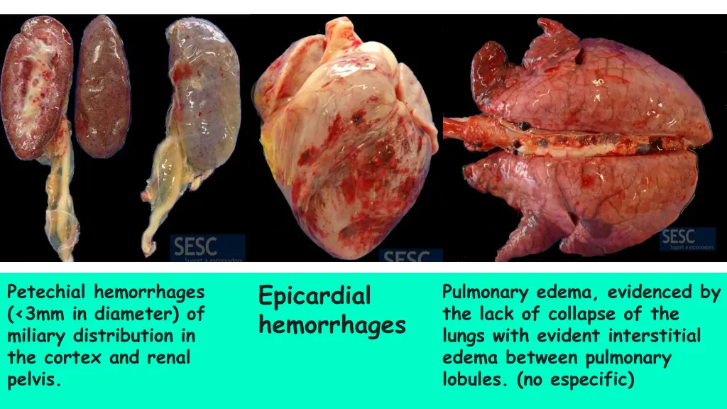 epicardial hemorrhages