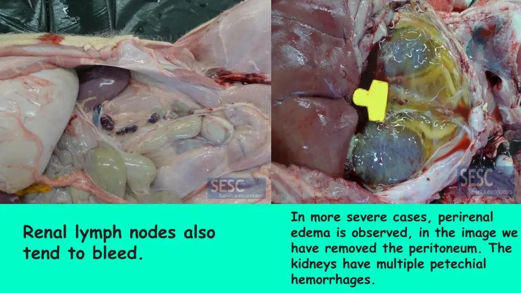 in more severe cases perirenal edema is observed