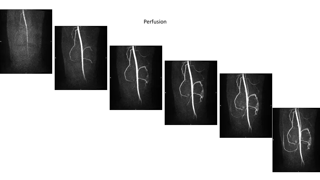 perfusion