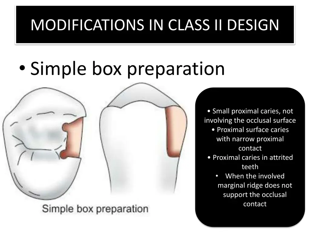 modifications in class ii design
