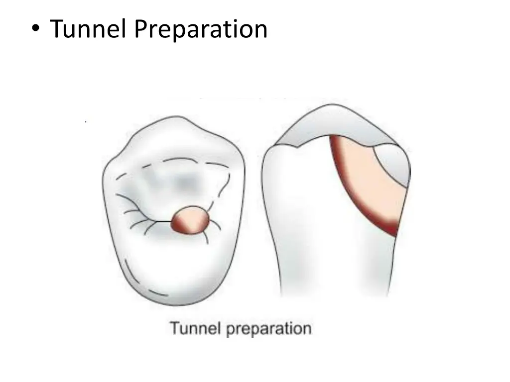 tunnel preparation