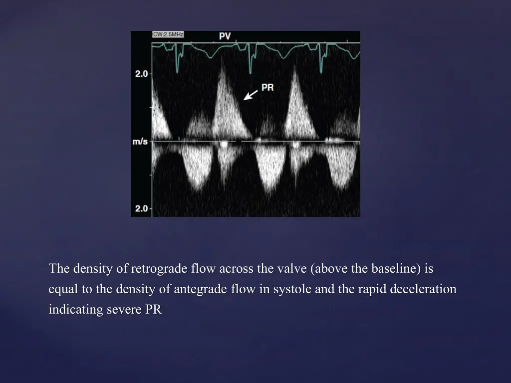 the density of retrograde flow across the valve