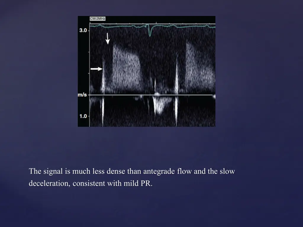 the signal is much less dense than antegrade flow