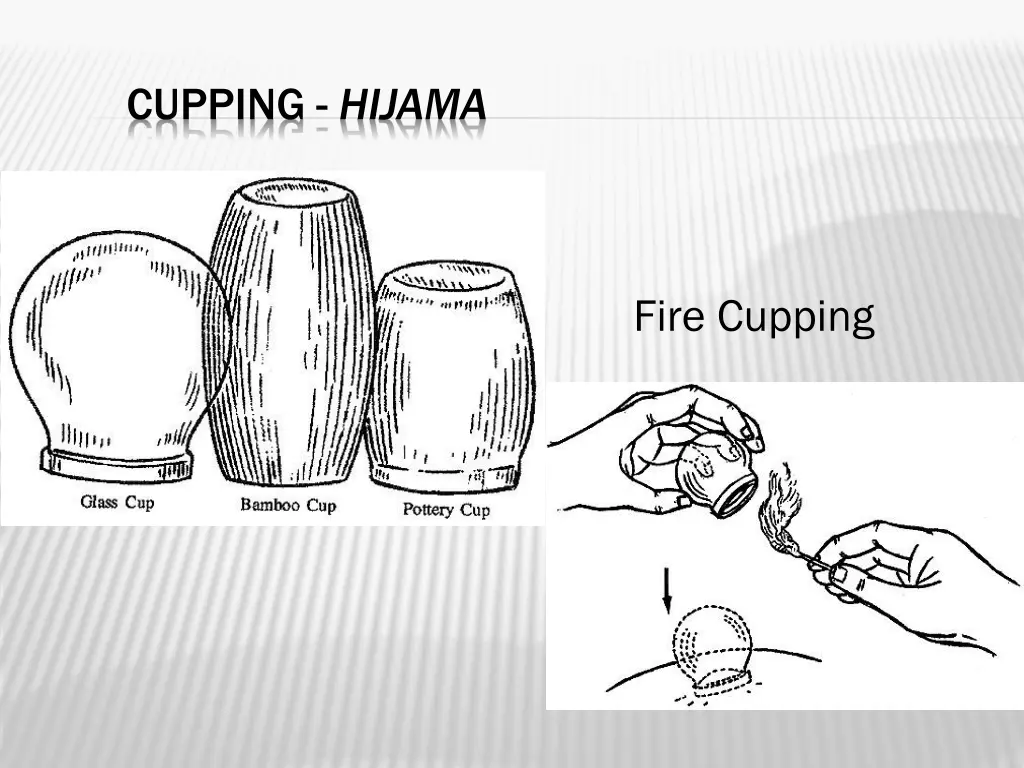 cupping hijama