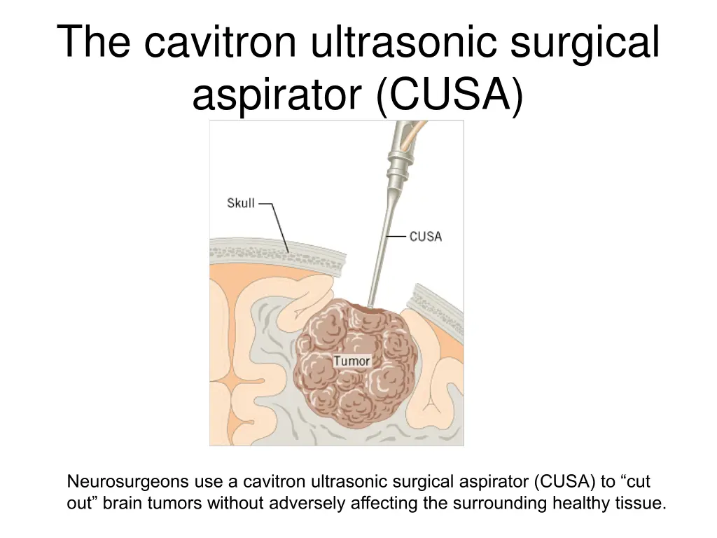 the cavitron ultrasonic surgical aspirator cusa