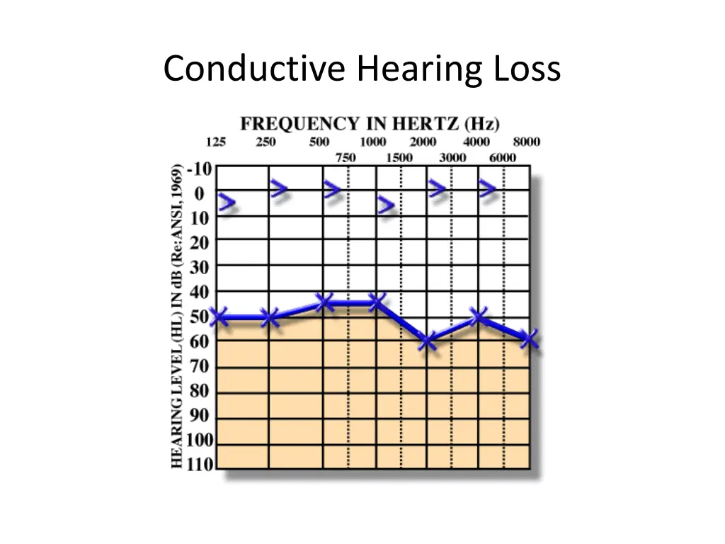 conductive hearing loss