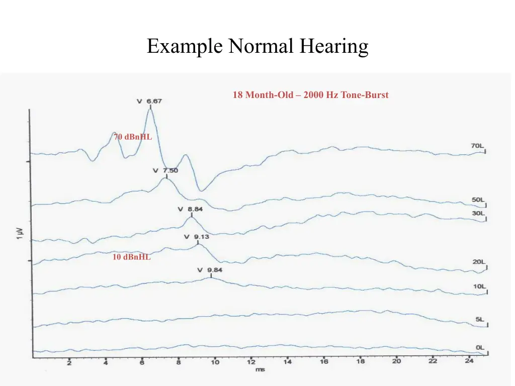 example normal hearing