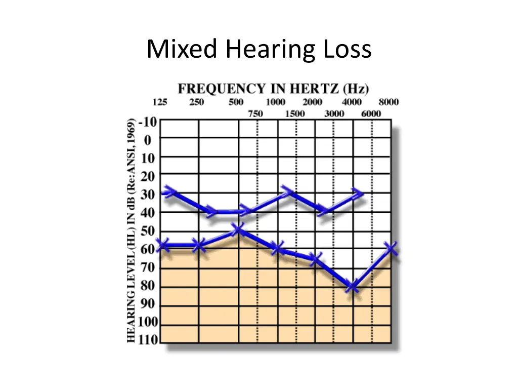 mixed hearing loss