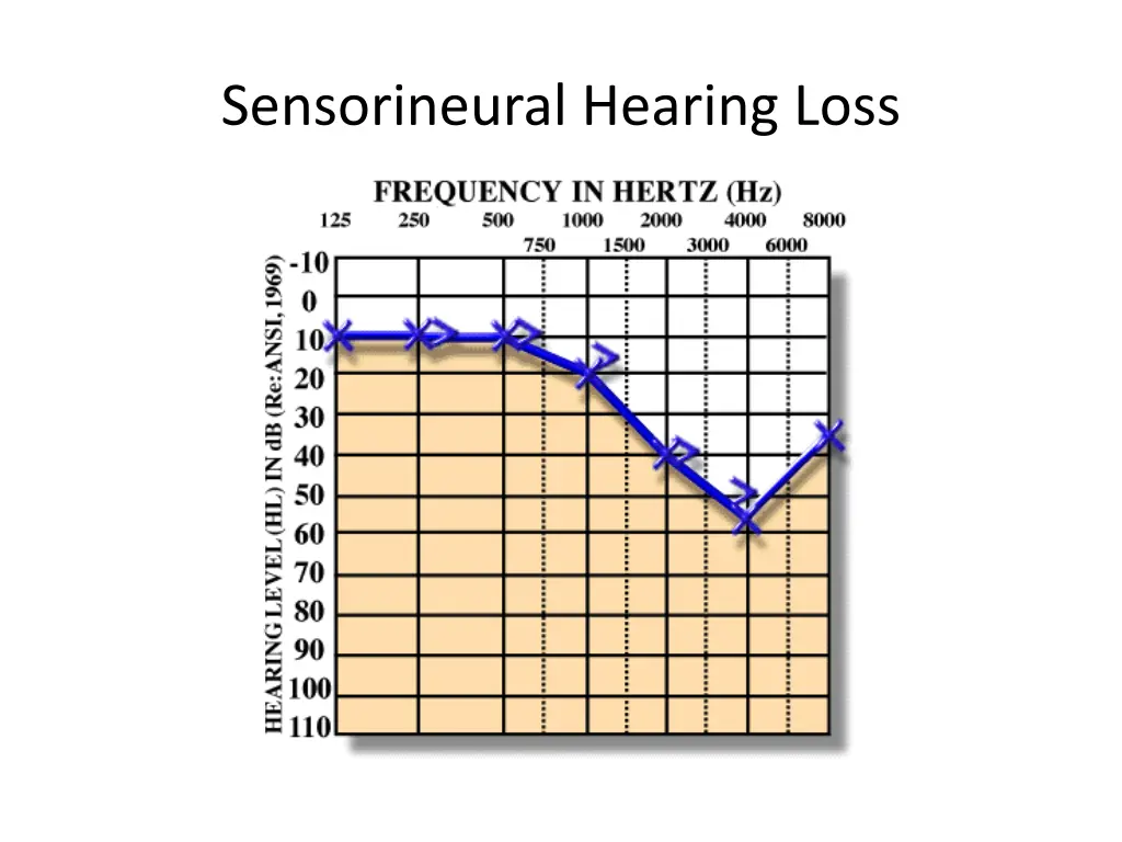 sensorineural hearing loss