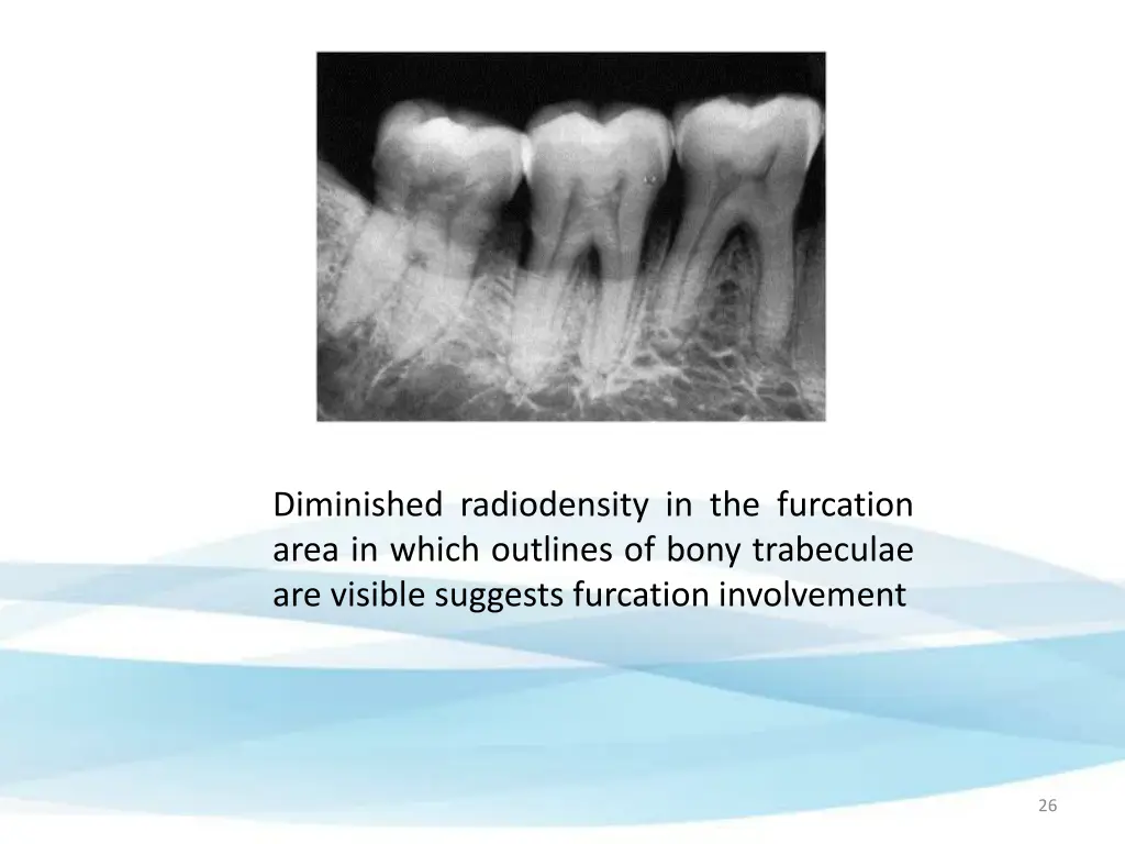 diminished radiodensity in the furcation area
