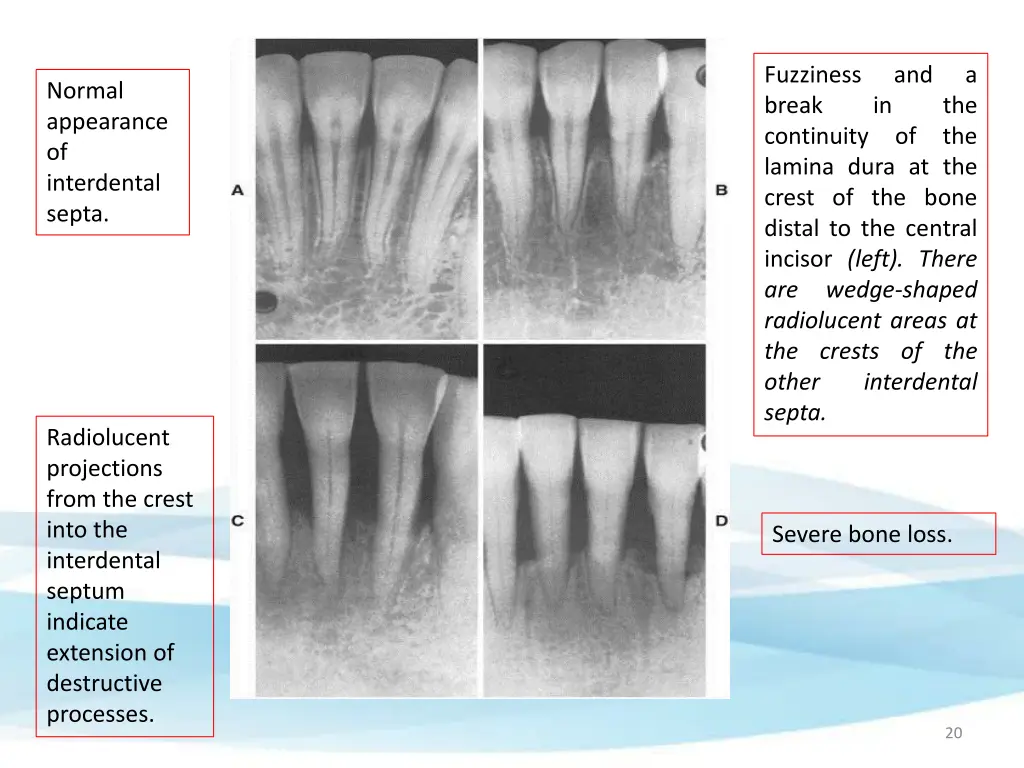 fuzziness break continuity of the lamina dura