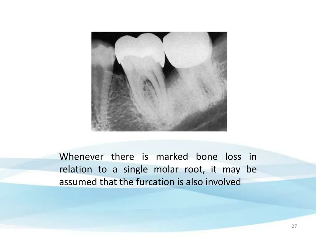 whenever there is marked bone loss in relation