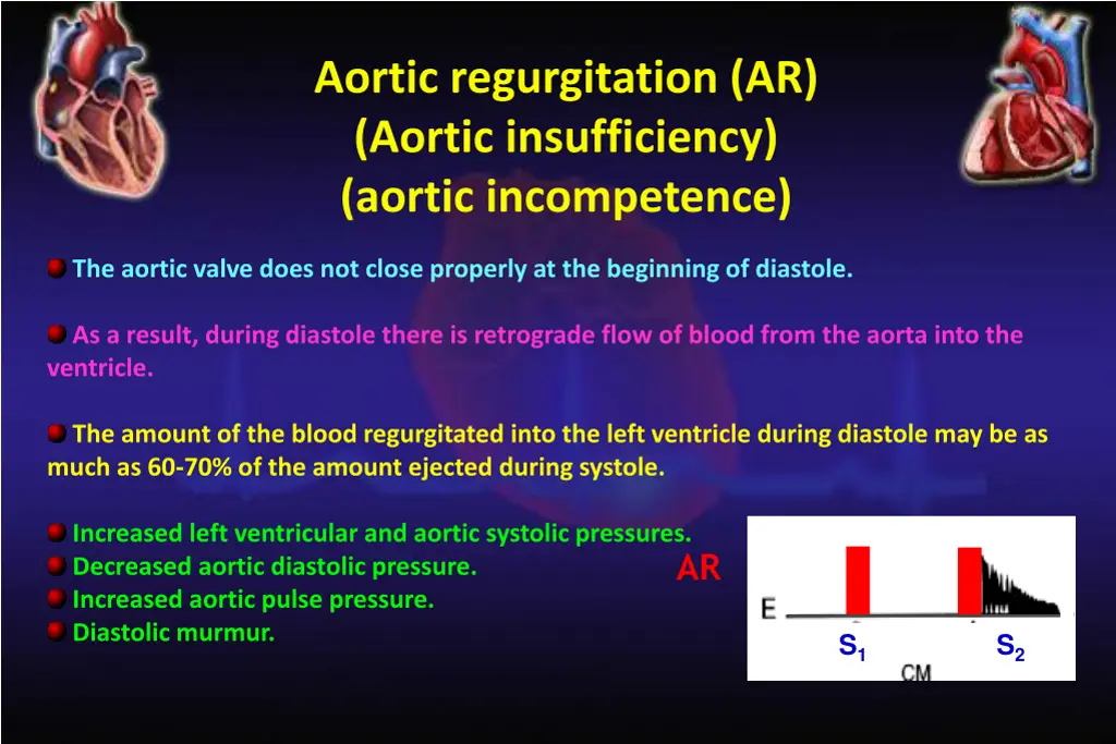 aortic regurgitation ar aortic insufficiency