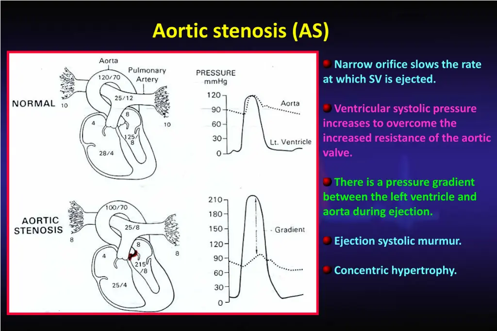 aortic stenosis as