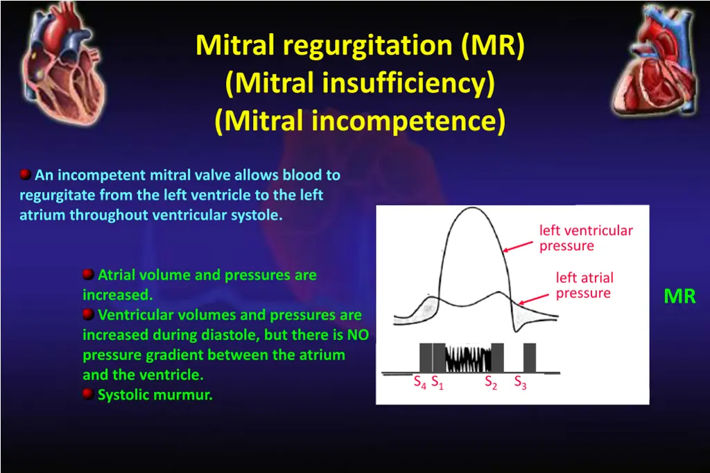 mitral regurgitation mr mitral insufficiency