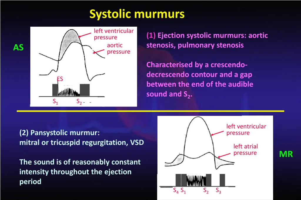 systolic murmurs