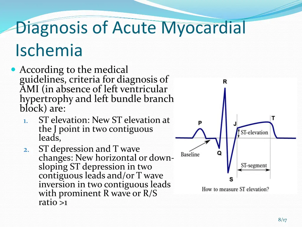 diagnosis of acute myocardial ischemia according