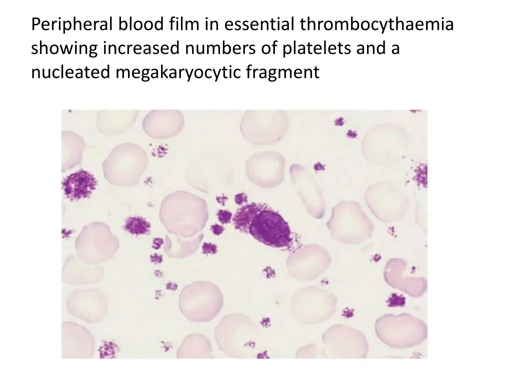 peripheral blood film in essential