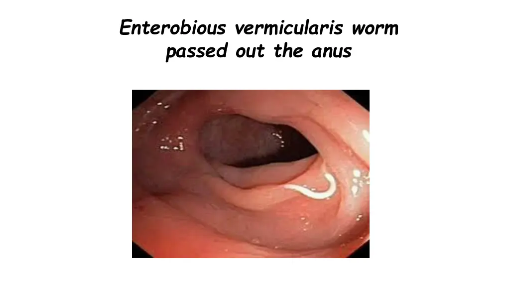 enterobious vermicularis worm passed out the anus