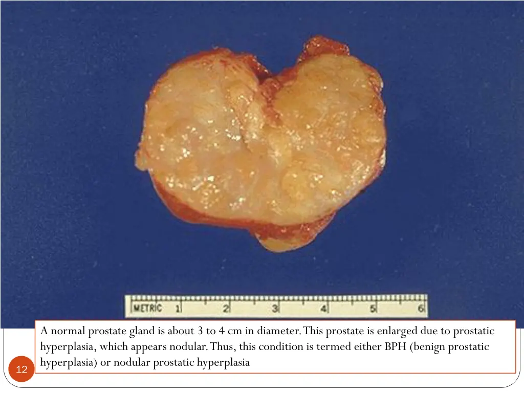 a normal prostate gland is about