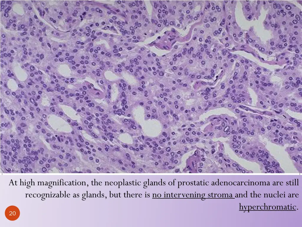 at high magnification the neoplastic glands