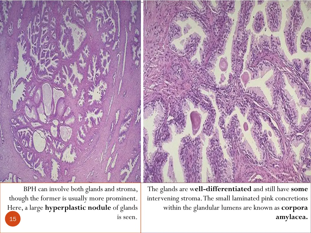 bph can involve both glands and stroma though