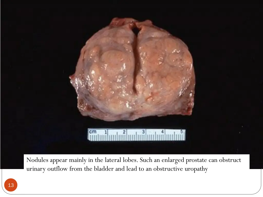 nodules appear mainly in the lateral lobes such