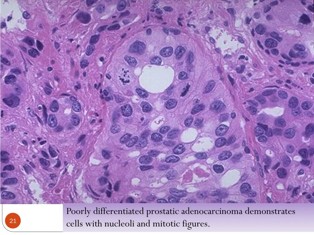 poorly differentiated prostatic adenocarcinoma