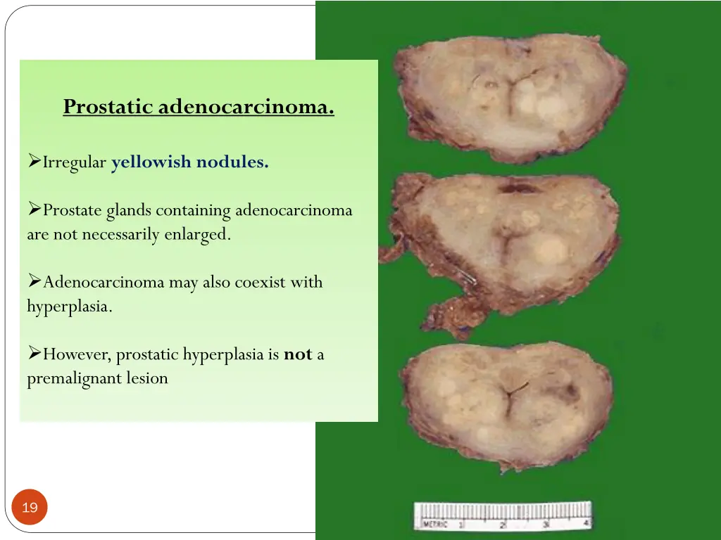 prostatic adenocarcinoma 2