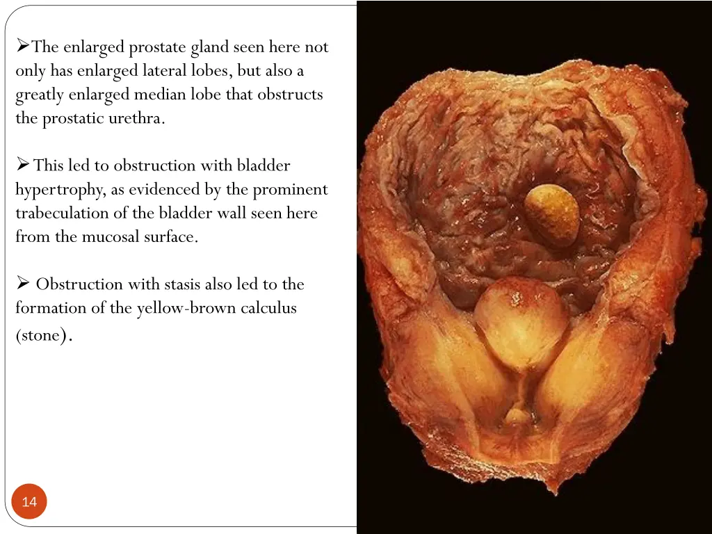 the enlarged prostate gland seen here not only