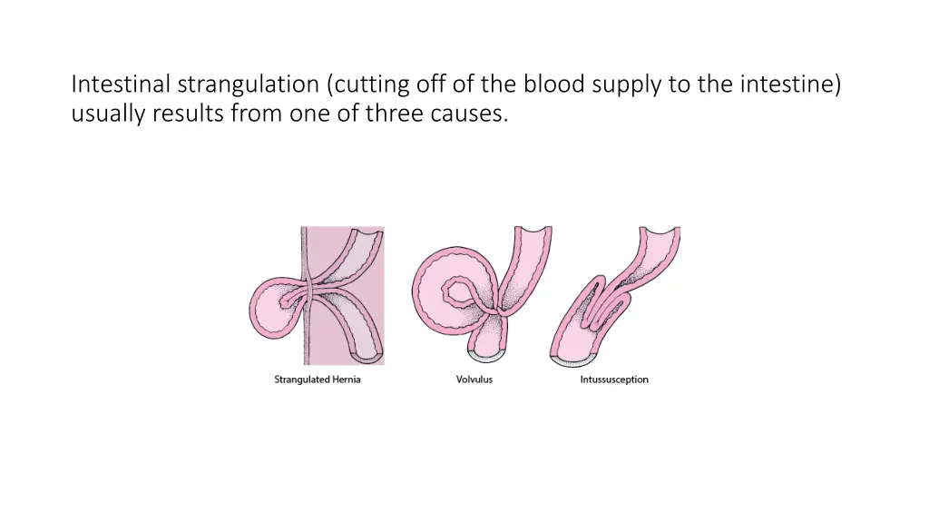intestinal strangulation cutting off of the blood