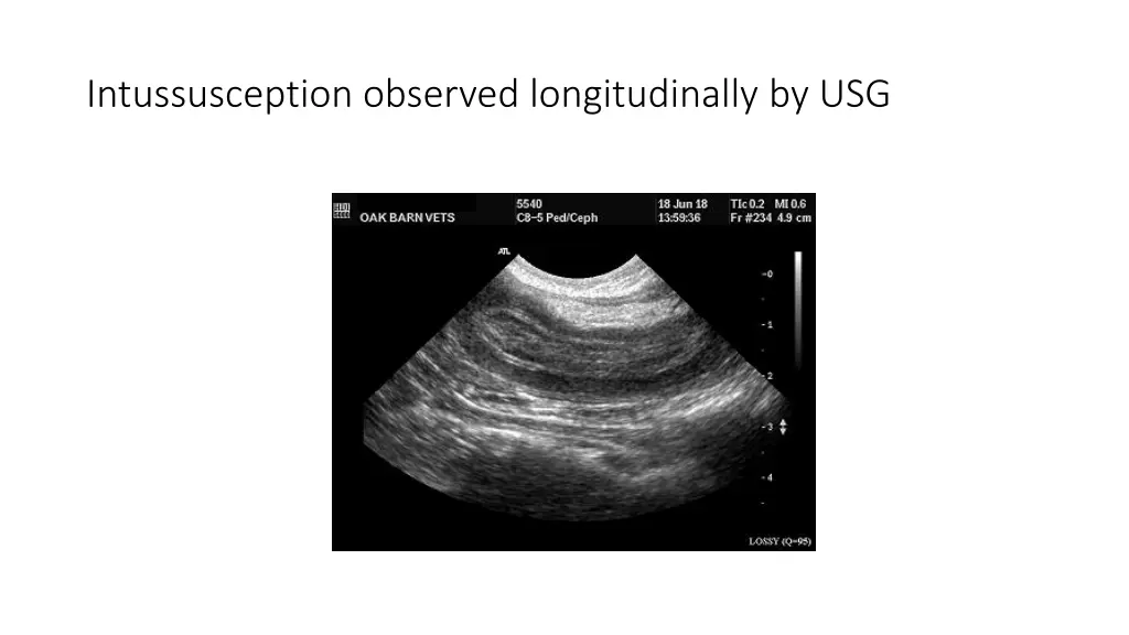 intussusception observed longitudinally by usg