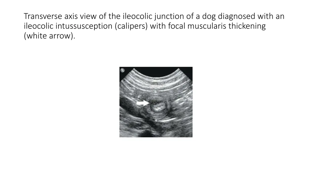 transverse axis view of the ileocolic junction