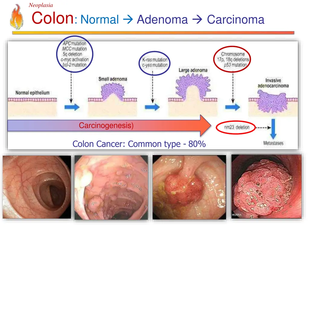 neoplasia colon normal adenoma carcinoma